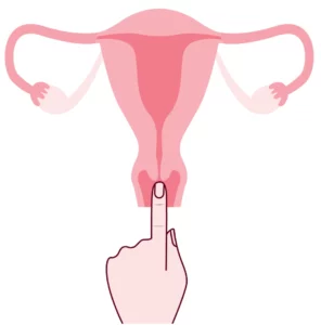 Nisko położona szyjka macicy