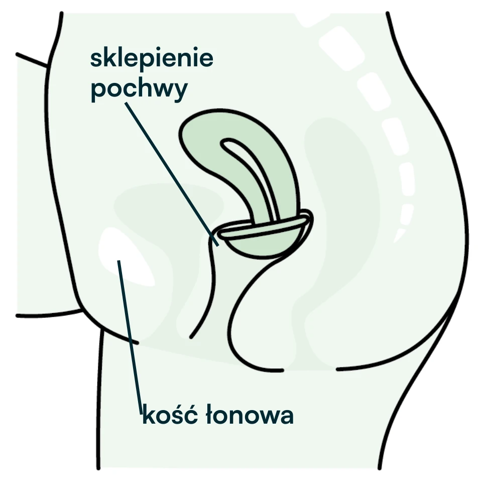 położenie dysku menstruacyjnego