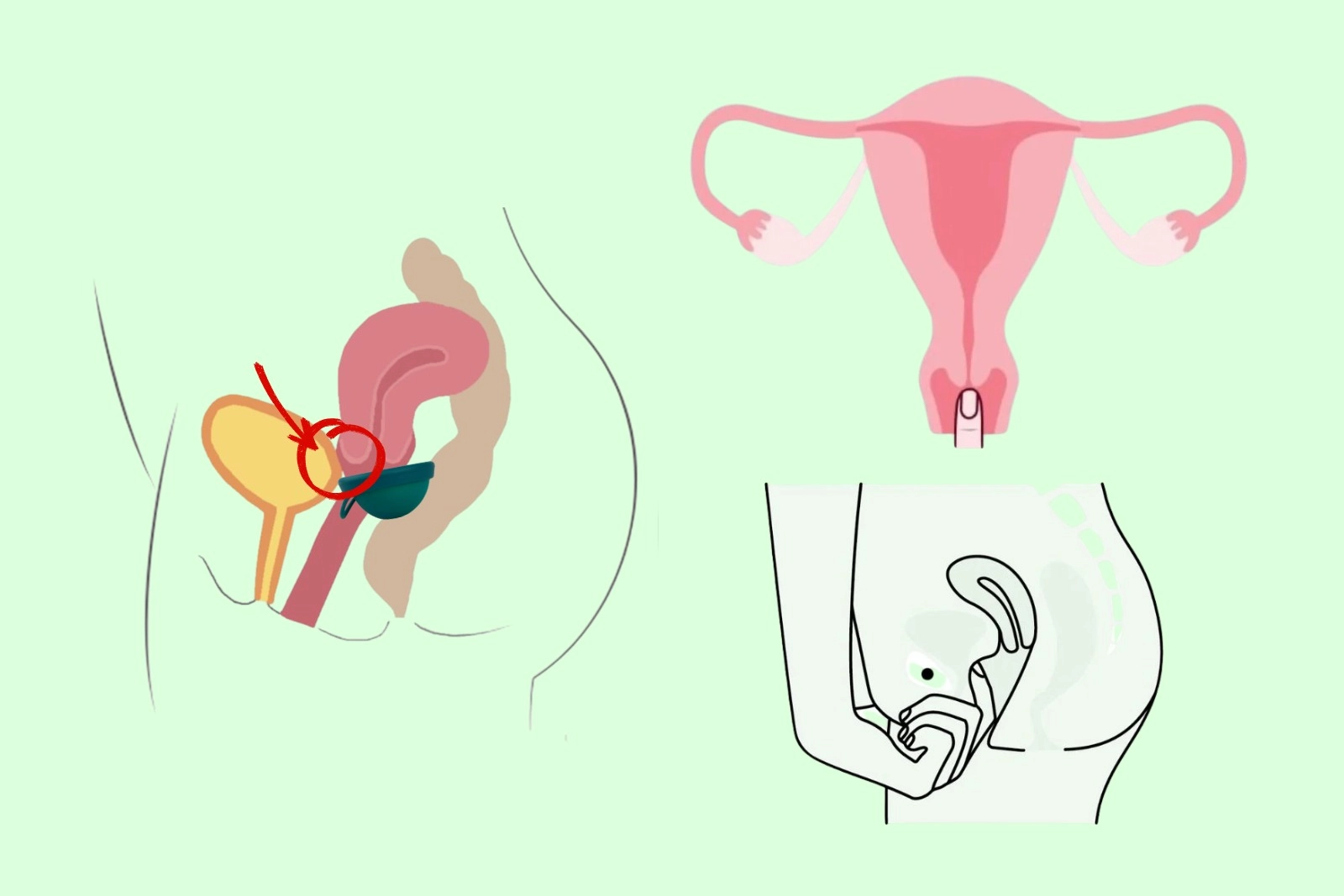 kiedy dysk menstruacyjne nie pasuje nisko położona szyjka macicy, płaska kość łonowa, tyłozgięcie MACICY