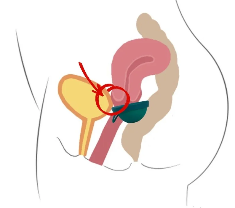 tyłozgięcie macicy a dysk menstruacyjny